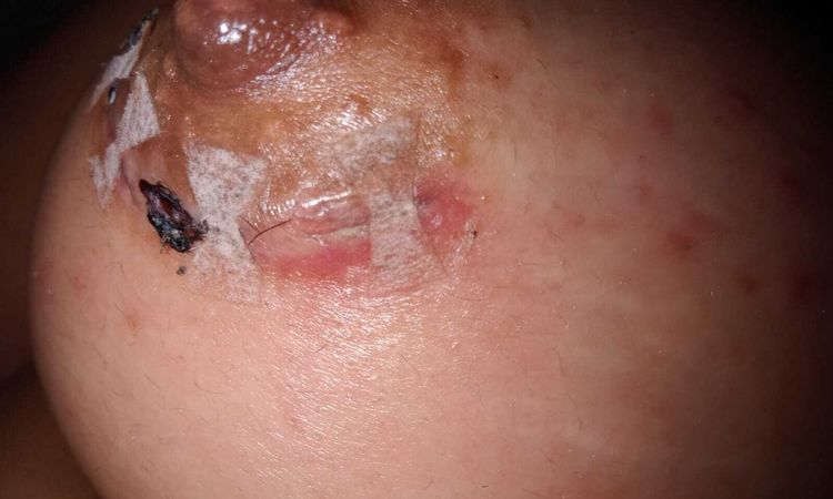 Posible infección en cicatriz post aumento de pecho - 57566