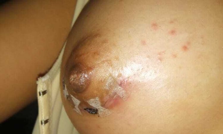 Posible infección en cicatriz post aumento de pecho - 57568