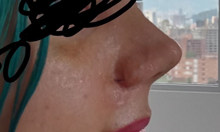 Cintas después de rinoplastia en nariz muy respingada - 57583