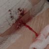 Punto de mastopexia abierto para drenar hematoma