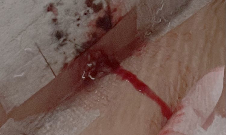 Punto de mastopexia abierto para drenar hematoma - 57585