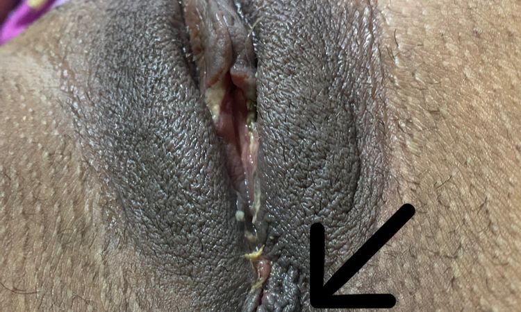 Bultos y piel arrugada en sutura de labioplastia - 57622