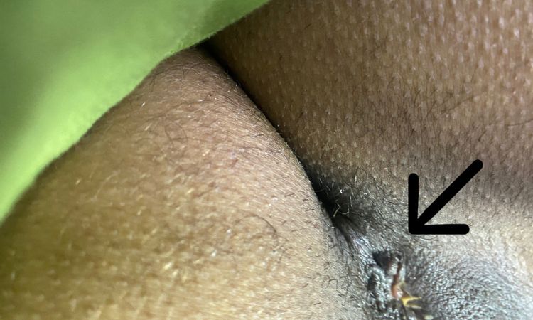 Bultos y piel arrugada en sutura de labioplastia - 57623
