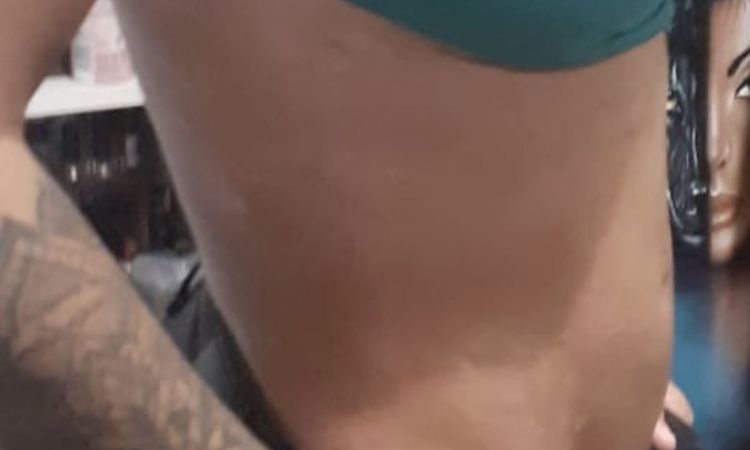 Inflamación abdominal al retirar la faja tras 3 meses de lipotransferencia - 57646