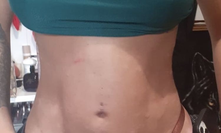 Inflamación abdominal al retirar la faja tras 3 meses de lipotransferencia - 57647
