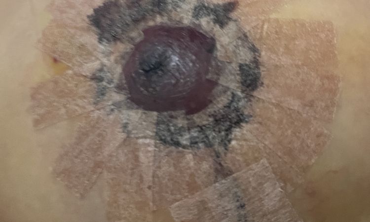 ¿Mi pezón tiene necrosis? - 57651