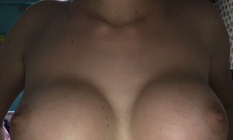¿Sinmastia o inflamación tras 1 año de aumento de pecho? - 57773