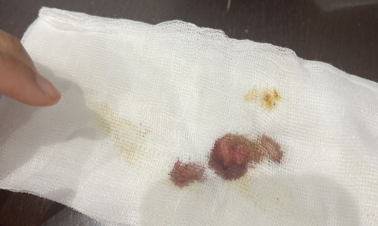 Sangrado por la zona de la T 10 días después de mastopexia - 57836