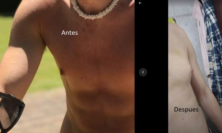 No veo resultados tras mi ginecomastia - 57882
