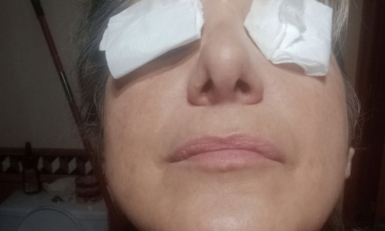 ¿Es posible corregir nariz bulbosa tras 11 meses de rinoplastia? - 57965