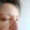 ¿Es posible corregir nariz bulbosa tras 11 meses de rinoplastia? - 57967