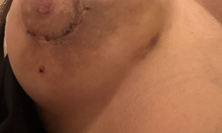 Encapsulamiento un día después de operar para corregir? - 58115