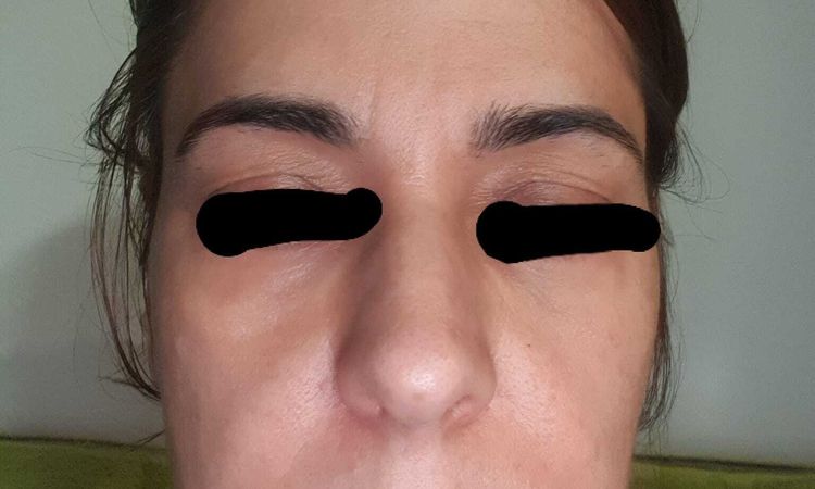 Resultados en flacidez de Facetite y blefaroplasta - 58185