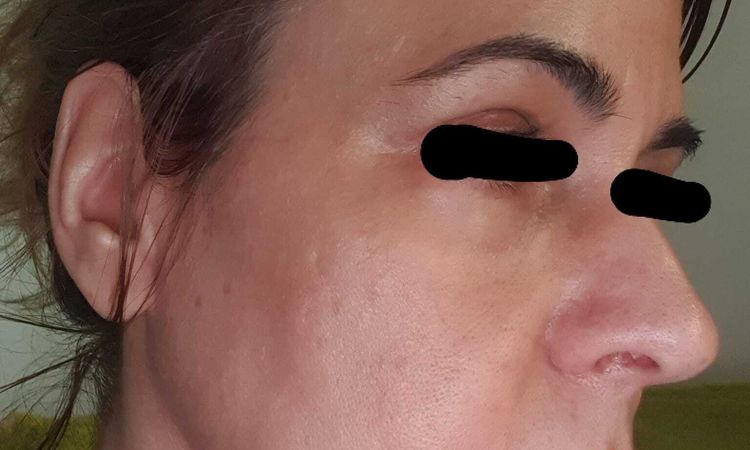 Resultados en flacidez de Facetite y blefaroplasta - 58186