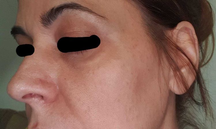 Resultados en flacidez de Facetite y blefaroplasta - 58187