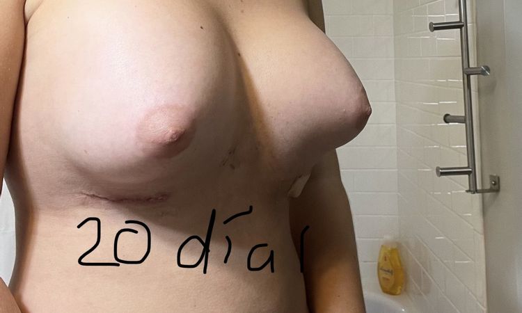 Aumento de pecho en mamas tuberosas un mes después sin resultados - 58432