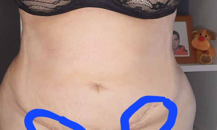 Inflamación y 2 bultos en abdomen bajo después de lipoescultura - 58611