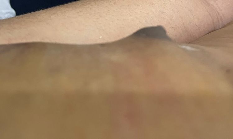 Areolas grandes tras ginecomastia - 58649