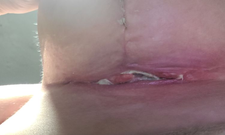 Herida abierta y supurando en T de mastopexia tras 1 mes de la operación - 58691