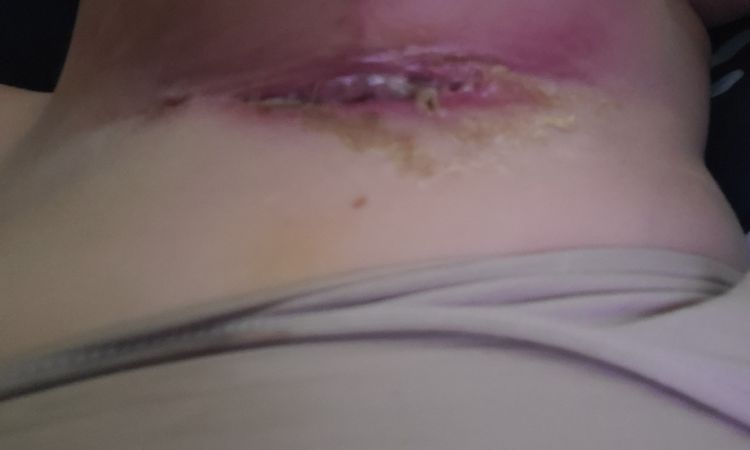Herida abierta y supurando en T de mastopexia tras 1 mes de la operación - 58692