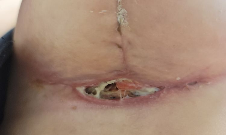 Herida abierta y supurando en T de mastopexia tras 1 mes de la operación - 58693