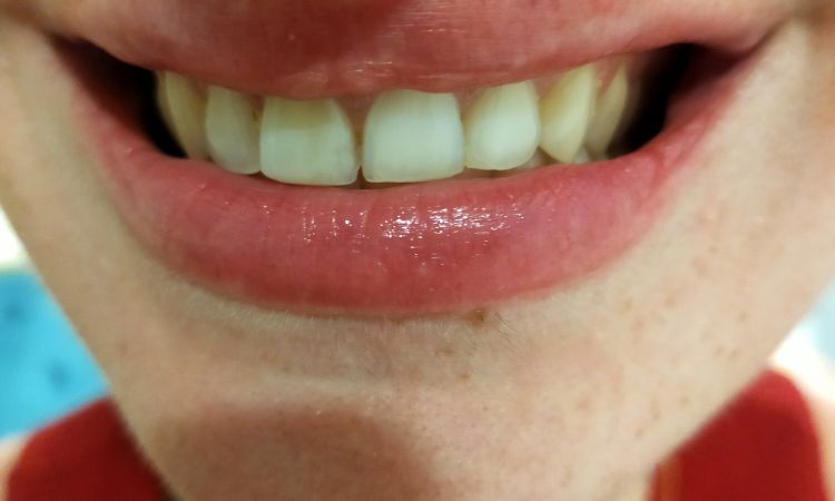 Hueco tras perfilado de labios con ácido hialurónico - 58714