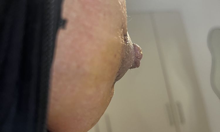 ¿Se me quedó el pezón retraído? - 58762
