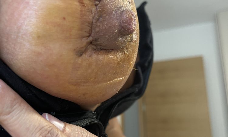 ¿Se me quedó el pezón retraído? - 58763