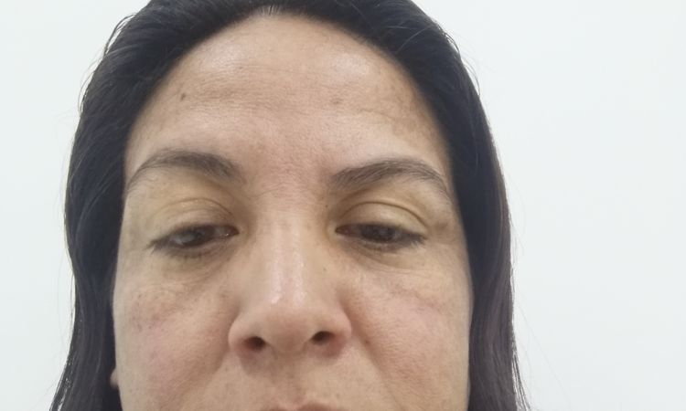 Flacidez e inflamación tras láser Fotona Tensado 4D en rostro - 58796