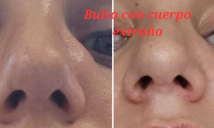 Inflamación no desaparece tras 14 meses de rinoplastia ultrasónica - 58894