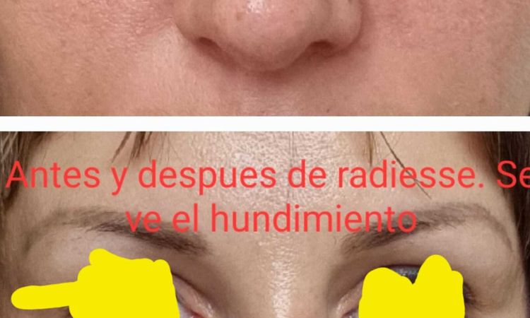 Inflamación no desaparece tras 14 meses de rinoplastia ultrasónica - 58895