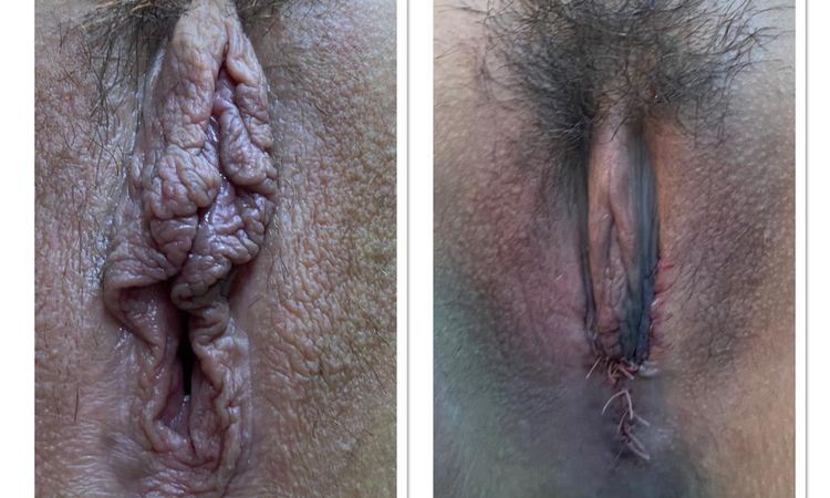 ¿Es correcto este procedimiento en labioplastia? - 58920