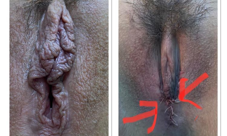 ¿Es correcto este procedimiento en labioplastia? - 58921
