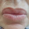 Aumento de labios con permanente Aquamid - 59016