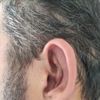 Otoplastia - inflamacion cartilago - 59062