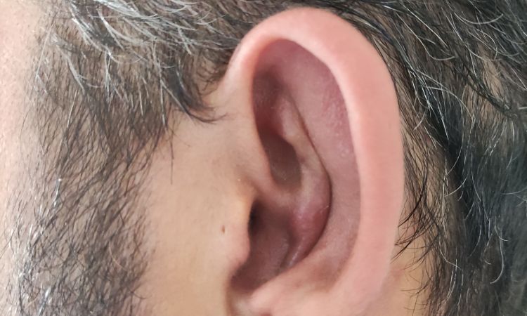 Otoplastia - inflamacion cartilago - 59062