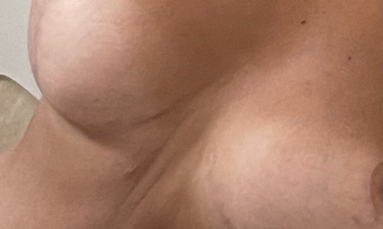 Mastopexia con prótesis anatómicas motiva, desformadas y mala cicatrización - 59071
