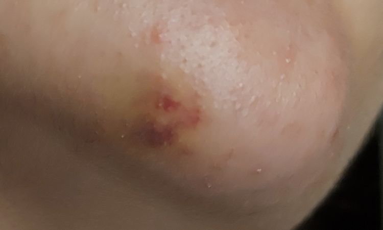 Mancha tras aumento de menton con acido hiluronico - 59137