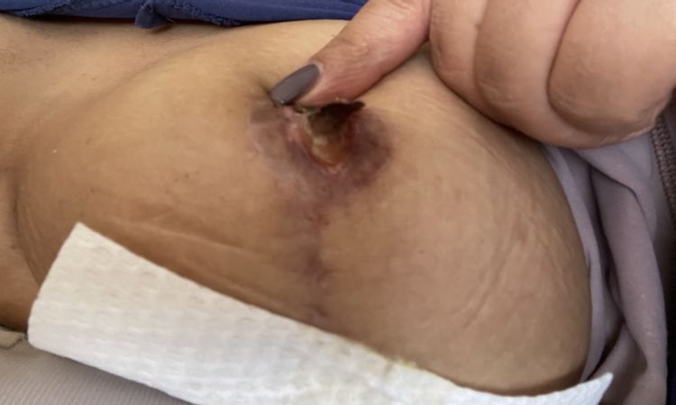 Sobre negrosis luego de mastopexia - 59258