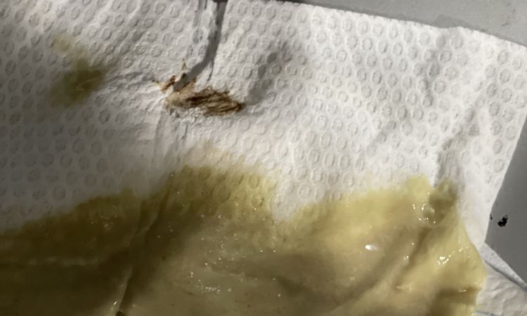 Sobre negrosis luego de mastopexia - 59260