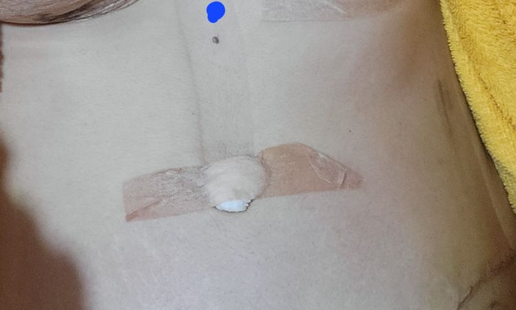 Punto interno abdominoplastia - 59277