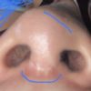 Arreglar columela de nariz, ausencia cartílago