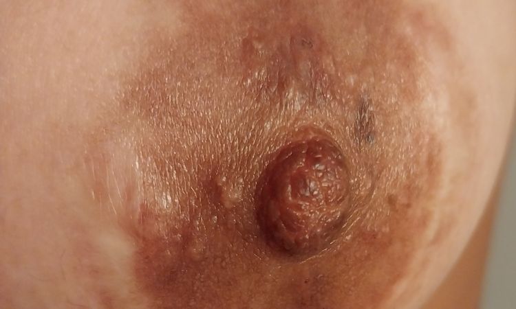 Picazon en la areola - 59341