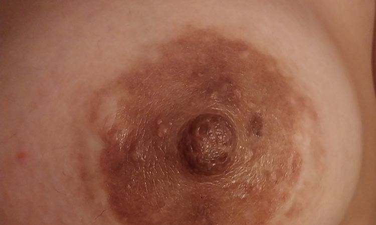Picazon en la areola - 59342