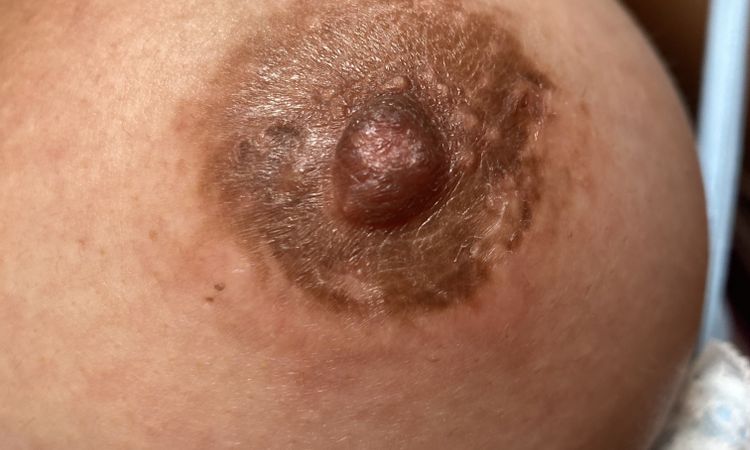 picazon y costra (descamación) en la areola - 59662