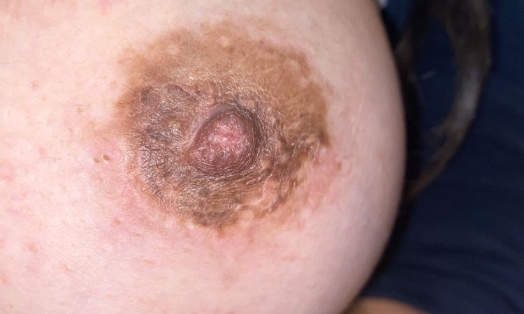 picazon y costra (descamación) en la areola - 59663