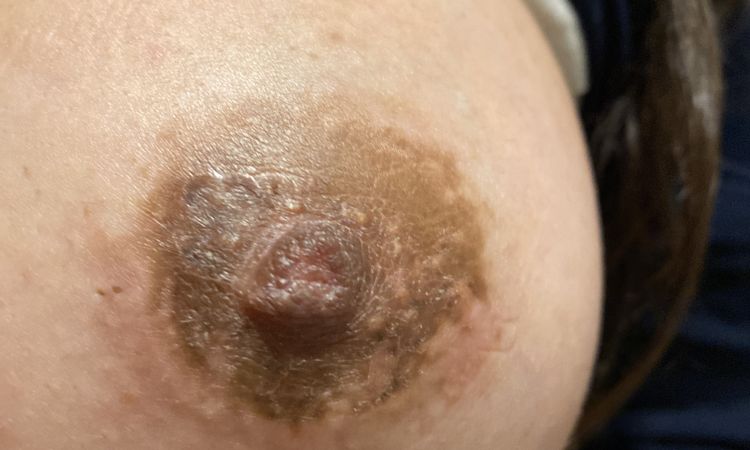 picazon y costra (descamación) en la areola - 59664