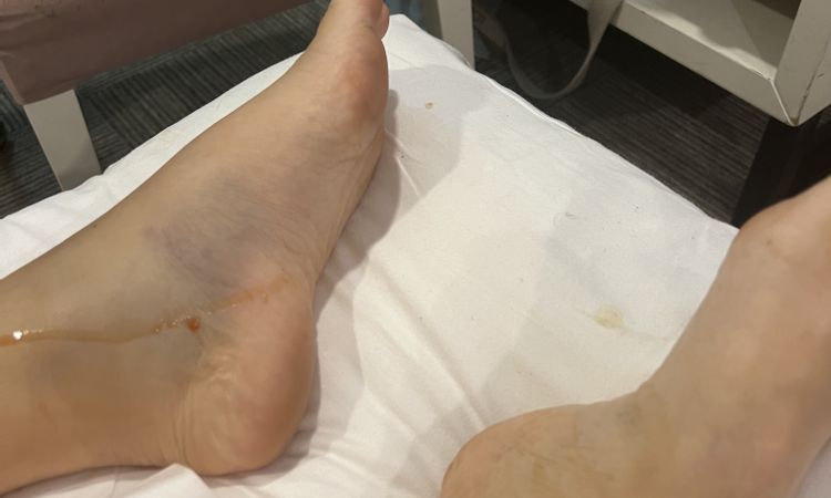 Pie inflamado tras lipoescultura - 59733