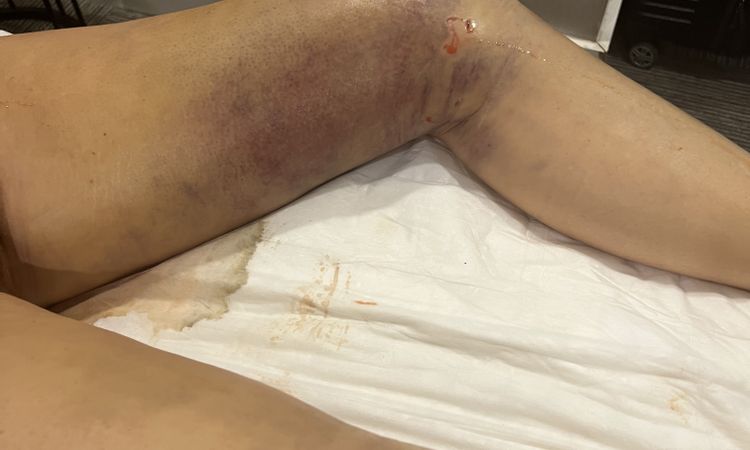 Pie inflamado tras lipoescultura - 59734