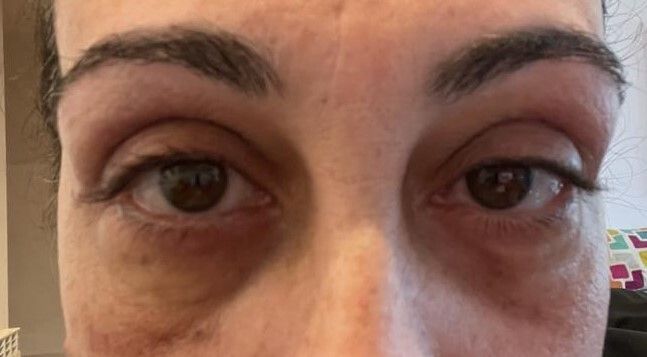 blefaroplastia y tic en parpado - 59995